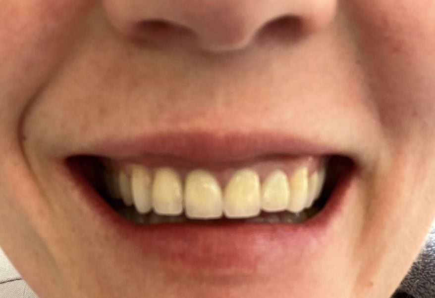 După tratament